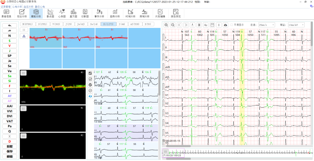 房早伴室内差异性传导与室性早搏智能鉴别